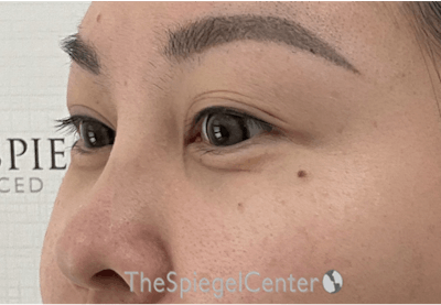 Tear Trough / Under Eye Fillers Before & After Gallery - Patient 405387 - Image 4