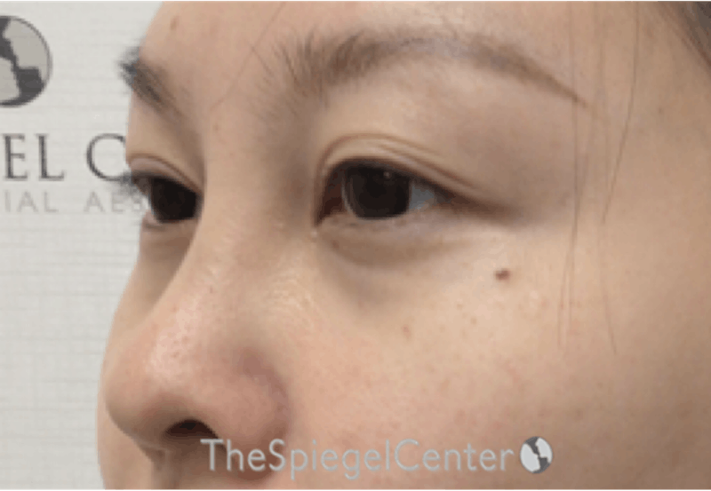 Tear Trough / Under Eye Fillers Before & After Gallery - Patient 405387 - Image 3