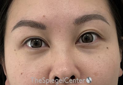 Tear Trough / Under Eye Fillers Before & After Gallery - Patient 405387 - Image 2