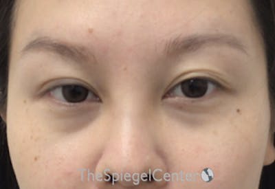 Tear Trough / Under Eye Fillers Before & After Gallery - Patient 405387 - Image 1