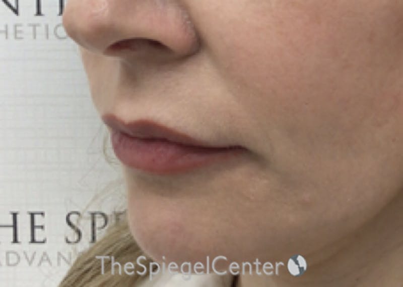 Nasolabial Fold Filler Before & After Gallery - Patient 258322 - Image 4