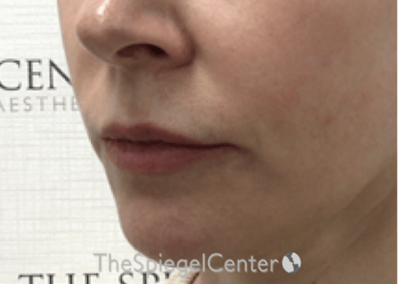 Nasolabial Fold Filler Before & After Gallery - Patient 258322 - Image 3
