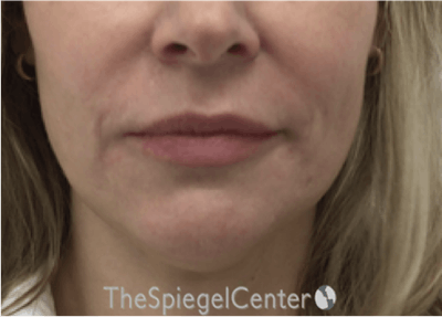 Nasolabial Fold Filler Before & After Gallery - Patient 258322 - Image 2