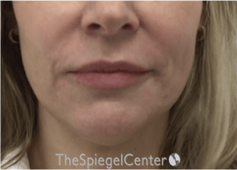 Nasolabial Fold Filler Before & After Gallery - Patient 258322 - Image 2