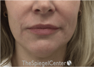 Nasolabial Fold Filler Before & After Gallery - Patient 258322 - Image 2