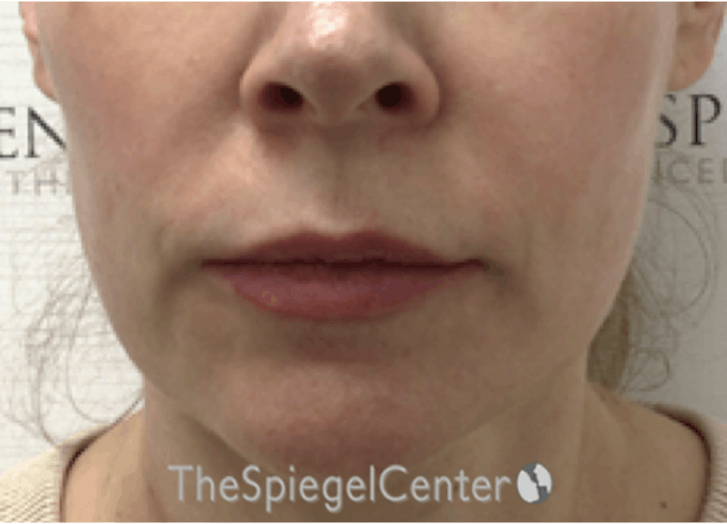 Nasolabial Fold Filler Before & After Gallery - Patient 258322 - Image 1