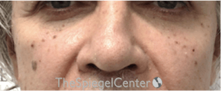 Cheek Implants Before & After Gallery - Patient 299815 - Image 4