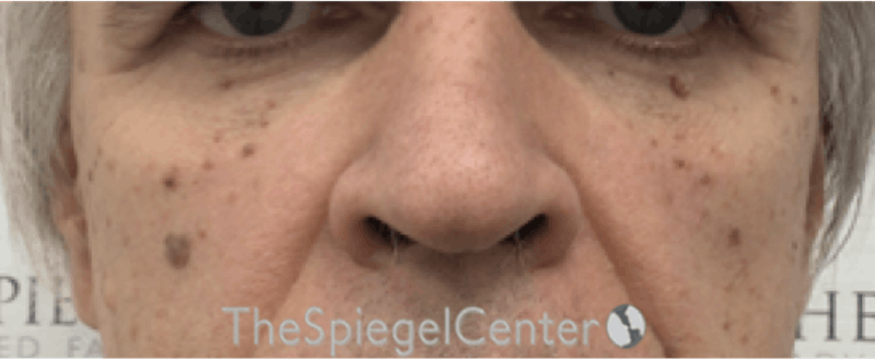 Cheek Implants Before & After Gallery - Patient 299815 - Image 3