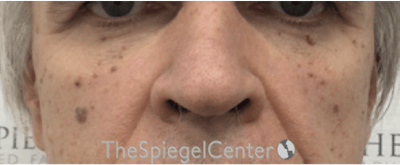 Cheek Implants Before & After Gallery - Patient 299815 - Image 3