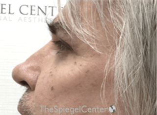 Cheek Implants Before & After Gallery - Patient 299815 - Image 2