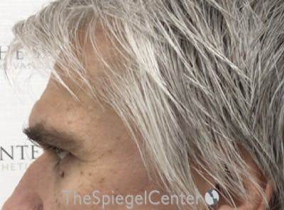 Forehead Contouring Before & After Gallery - Patient 146613 - Image 3