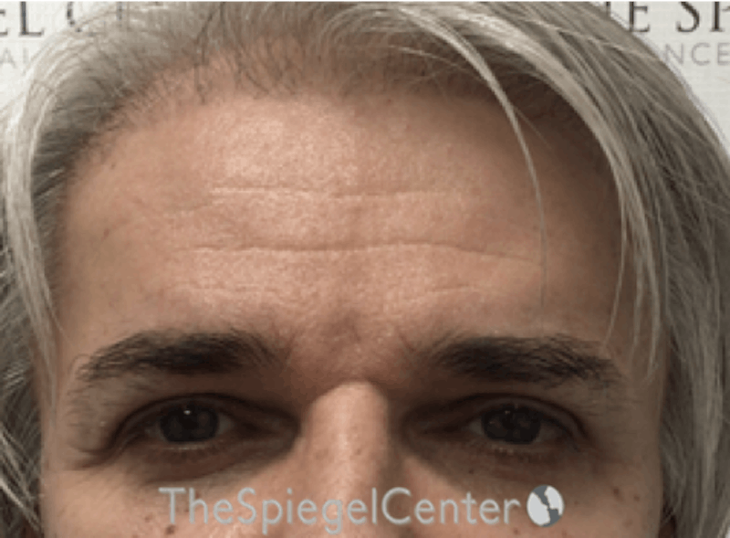 Forehead Contouring Before & After Gallery - Patient 146613 - Image 2