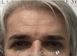 Forehead Contouring Before & After Gallery - Patient 146613 - Image 2