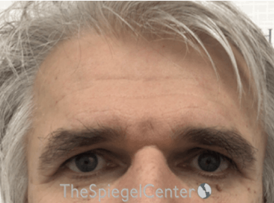 Forehead Contouring Before & After Gallery - Patient 146613 - Image 1