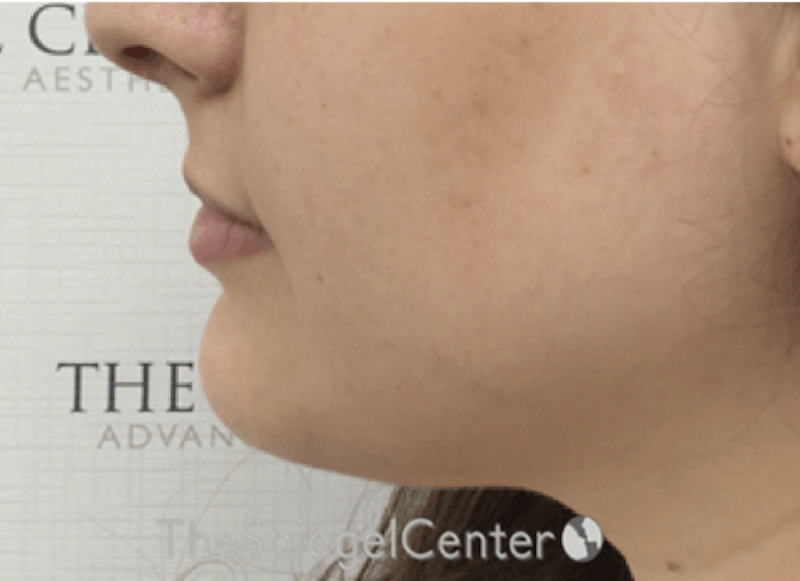 Chin Filler Before & After Gallery - Patient 217439 - Image 4