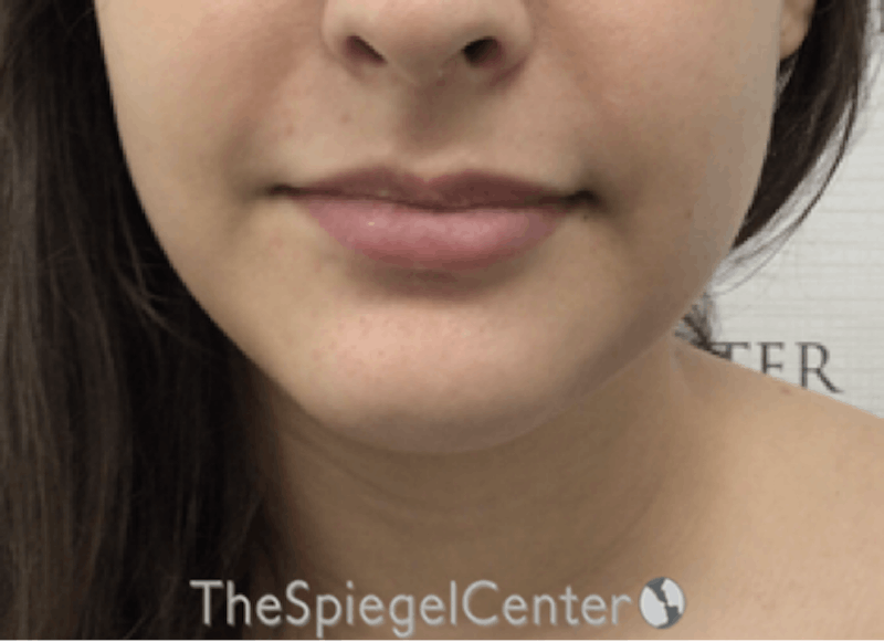Chin Filler Before & After Gallery - Patient 217439 - Image 2
