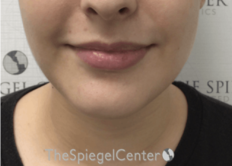 Chin Filler Before & After Gallery - Patient 217439 - Image 1
