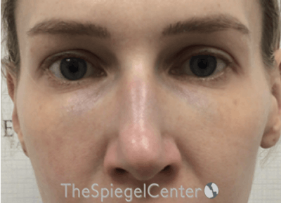 Non-Surgical Rhinoplasty / Nose Filler Before & After Gallery - Patient 157140569 - Image 1