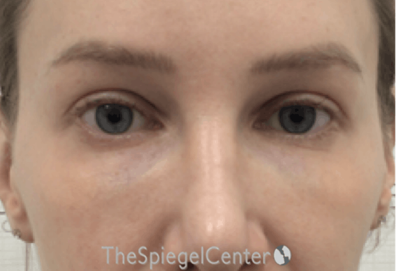 Temple Filler Before & After Gallery - Patient 697571 - Image 2