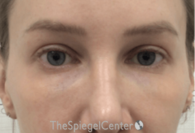 Temple Filler Before & After Gallery - Patient 697571 - Image 2