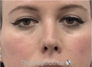 Rhinoplasty Before & After Gallery - Patient 252615 - Image 4