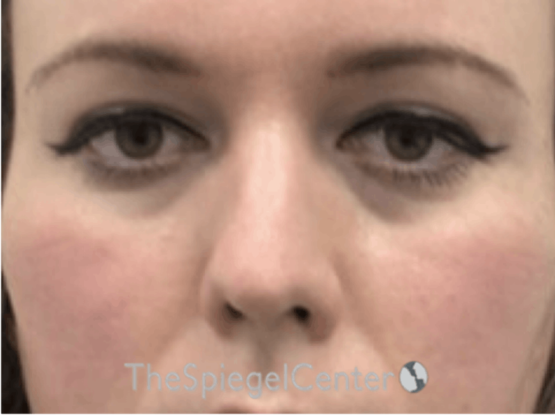 Rhinoplasty Before & After Gallery - Patient 252615 - Image 3