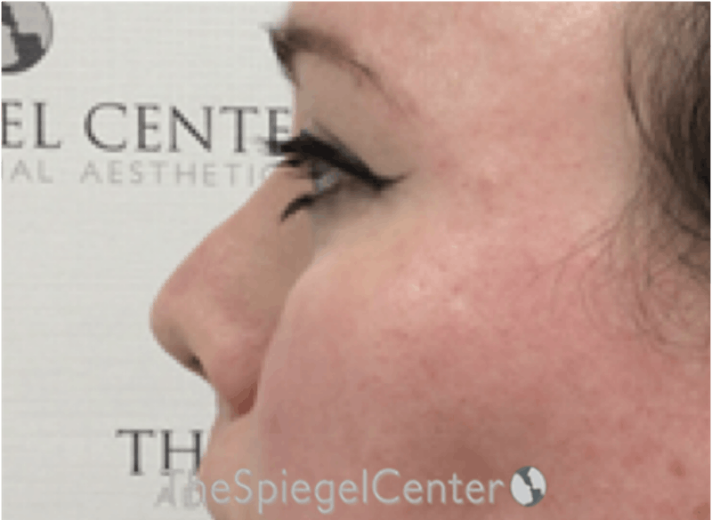 Rhinoplasty Before & After Gallery - Patient 252615 - Image 2