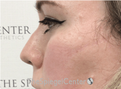 Rhinoplasty Before & After Gallery - Patient 252615 - Image 1