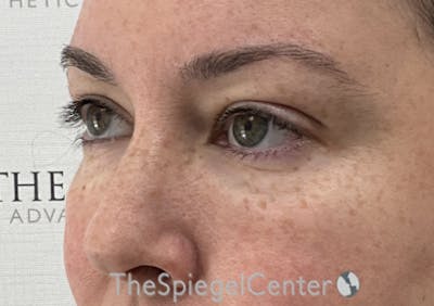 Tear Trough / Under Eye Fillers Before & After Gallery - Patient 280351 - Image 4
