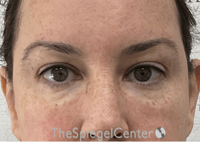 Tear Trough / Under Eye Fillers Before & After Gallery - Patient 280351 - Image 2