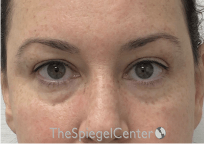 Tear Trough / Under Eye Fillers Before & After Gallery - Patient 280351 - Image 1
