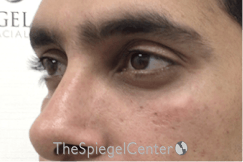 Upper Eyelid Filler Before & After Gallery - Patient 104438 - Image 4