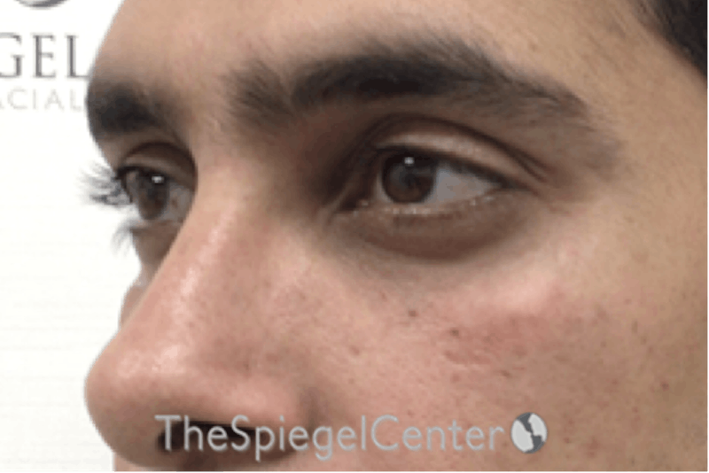 Tear Trough / Under Eye Fillers Before & After Gallery - Patient 157140684 - Image 4