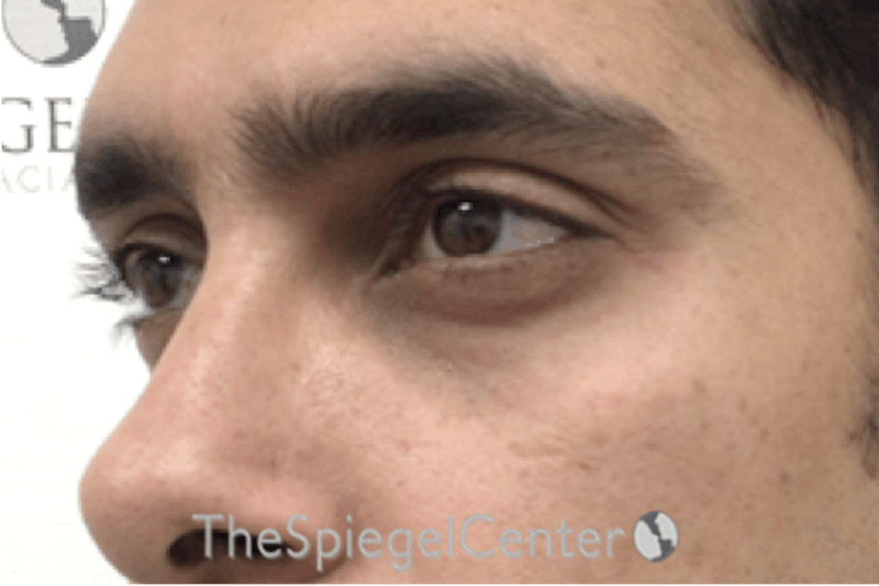 Upper Eyelid Filler Before & After Gallery - Patient 104438 - Image 3