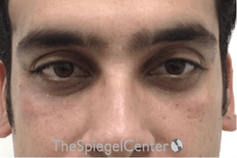 Upper Eyelid Filler Before & After Gallery - Patient 104438 - Image 2