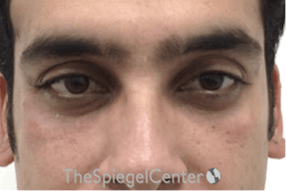 Tear Trough / Under Eye Fillers Before & After Gallery - Patient 157140684 - Image 2