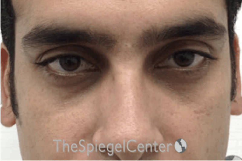 Upper Eyelid Filler Before & After Gallery - Patient 104438 - Image 1