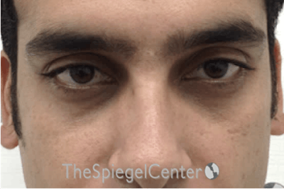 Upper Eyelid Filler Before & After Gallery - Patient 104438 - Image 1