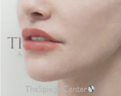 Lip Lift Before & After Gallery - Patient 277755 - Image 4