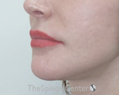 Lip Lift Before & After Gallery - Patient 277755 - Image 3