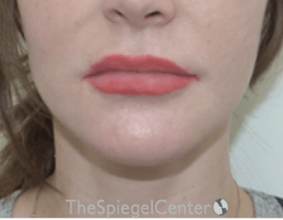 Lip Lift Before & After Gallery - Patient 277755 - Image 1
