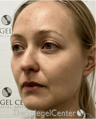 Buccal Fat Reduction Before & After Gallery - Patient 319252 - Image 4