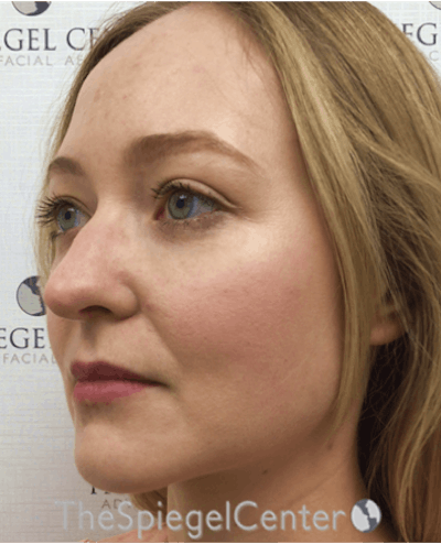 Buccal Fat Reduction Before & After Gallery - Patient 319252 - Image 3