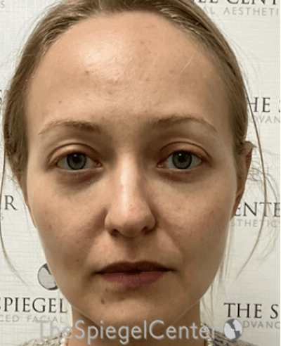 Buccal Fat Reduction Before & After Gallery - Patient 319252 - Image 2