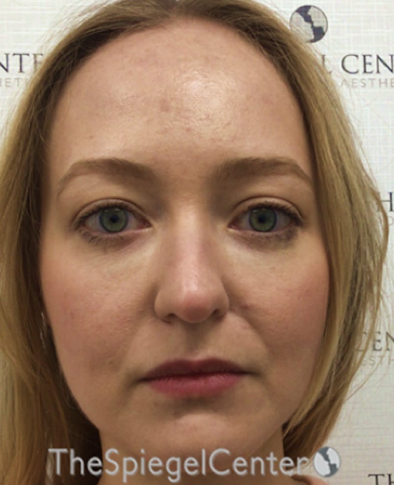 Buccal Fat Reduction Before & After Gallery - Patient 319252 - Image 1