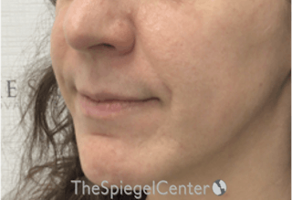 Nasolabial Fold Filler Before & After Gallery - Patient 356593 - Image 4
