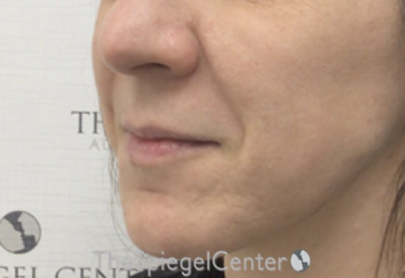 Nasolabial Fold Filler Before & After Gallery - Patient 356593 - Image 3