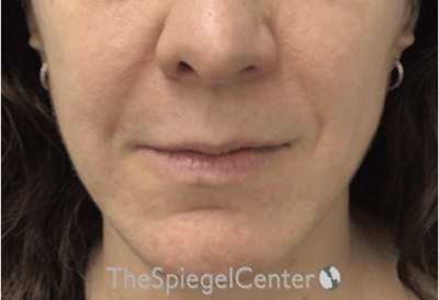 Nasolabial Fold Filler Before & After Gallery - Patient 356593 - Image 2