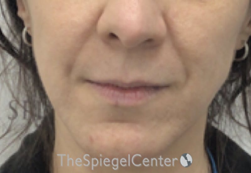 Nasolabial Fold Filler Before & After Gallery - Patient 356593 - Image 1