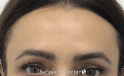 Browlift / Fox Eye Lift Before & After Gallery - Patient 125908 - Image 2